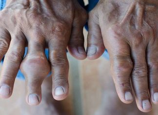 Arthrose: une journée mondiale pour sensibiliser ! arthrose